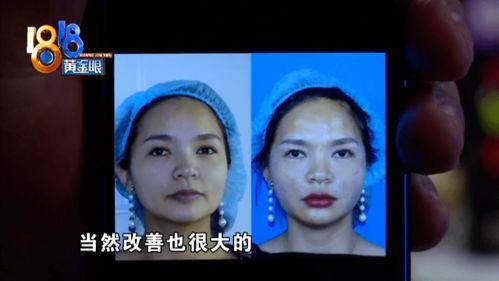 闺蜜整容前后爆料视频,揭秘整形术的神奇魔力 第3张 闺蜜整容前后爆料视频,揭秘整形术的神奇魔力 第3张